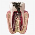 Anatomically Accurate Tooth Cross-Section Illustration With Cavity