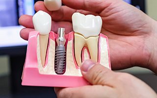 Сертифицированные и клинически проверенные импланты
